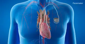 Pacemaker